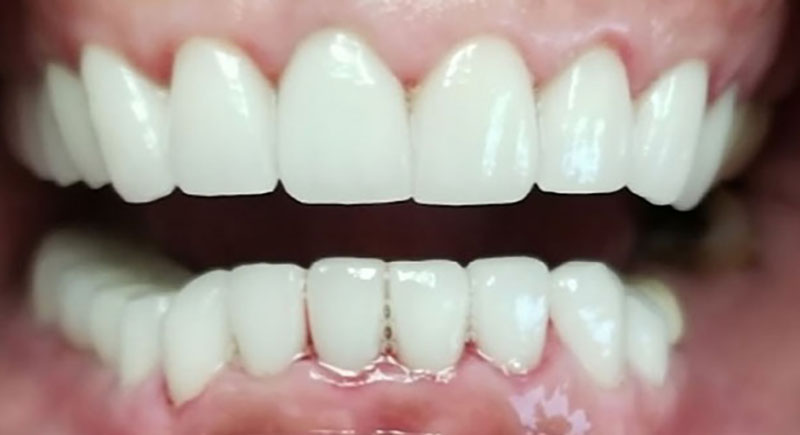 Dental Crown & Dental Bridge