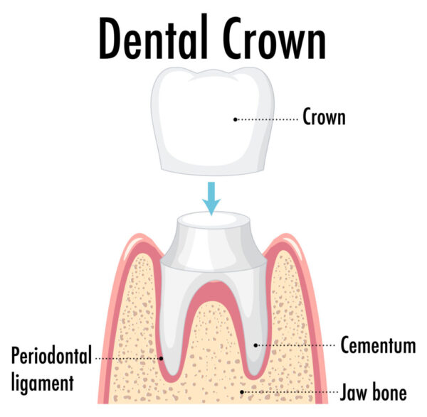 riverside dental crown